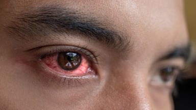6 loại thuốc trị đau mắt đỏ mà bạn nên biết