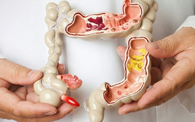 Viêm đại tràng polyp &#8211; Những kiến thức cần biết