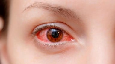 Khi nào bị đau mắt đỏ cần phải đi khám ngay