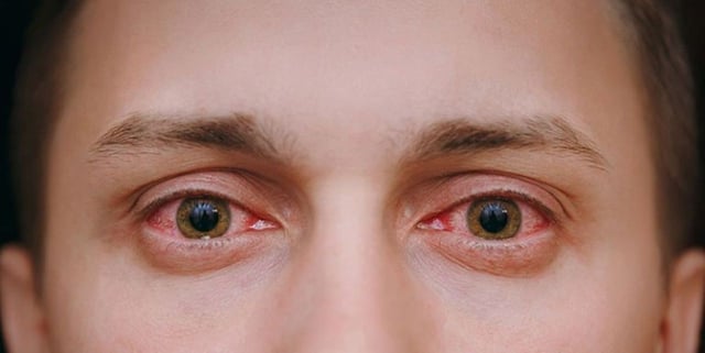 Dùng kháng sinh đau mắt đỏ: loại nào nên và không nên?