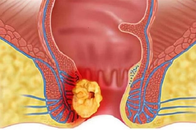 Phòng chống bệnh trĩ: Những biện pháp hiệu quả