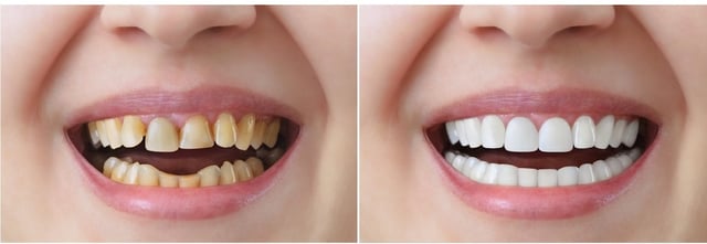 Mách bạn kinh nghiệm đi bọc răng sứ