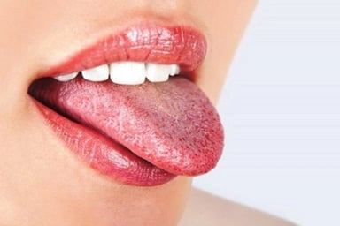 Bệnh nhân nấm miệng nên ăn gì và không nên ăn gì?