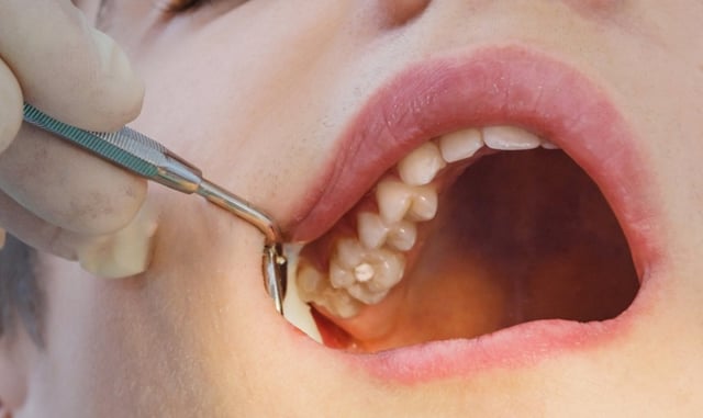 Mức độ nguy hiểm của nhổ răng khôn hàm trên