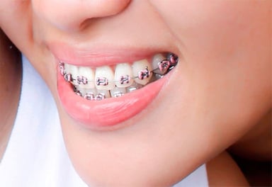 Bảng giá nắn chỉnh răng và các yếu tố tác động