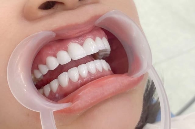 Chi phí bọc răng sứ cả hàm hiện nay