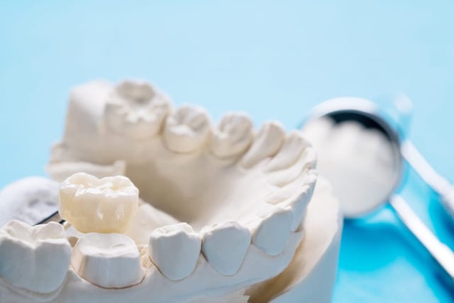 Giải đáp: Bọc răng sứ độ bền bao lâu?