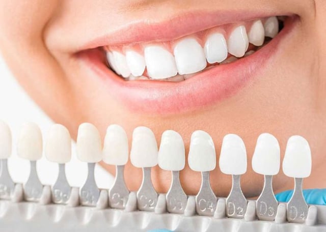 Bọc răng sứ hai răng cửa và những trường hợp cần thực hiện