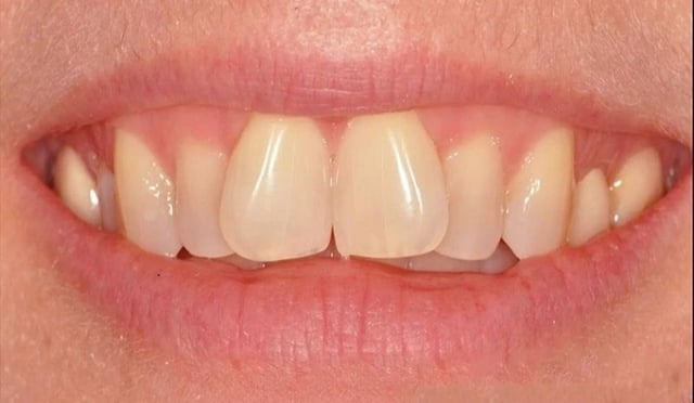 Các phương pháp chỉnh sửa răng mọc lệch hiệu quả