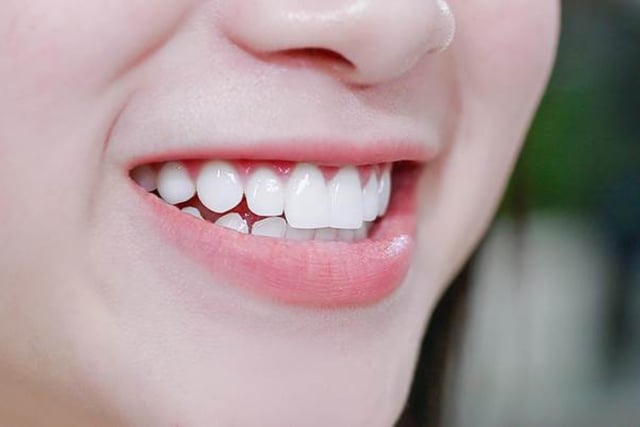 Những lý do nên trồng răng sứ