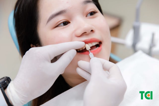 Giải đáp thắc mắc: Dán sứ veneer có mấy loại?