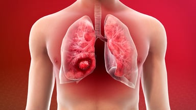 Hiểu về phương pháp điều trị đích trong ung thư phổi