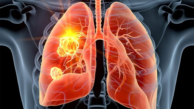 Tìm hiểu các cách chữa bệnh ung thư phổi không tế bào nhỏ