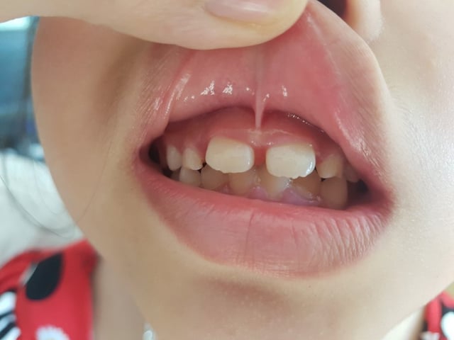 Những vấn đề liên quan đến hàn khe răng thưa