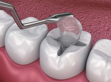Hàn răng ở đâu an toàn, hiệu quả và những lưu ý