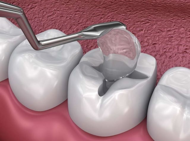 Hàn răng ở đâu an toàn, hiệu quả và những lưu ý