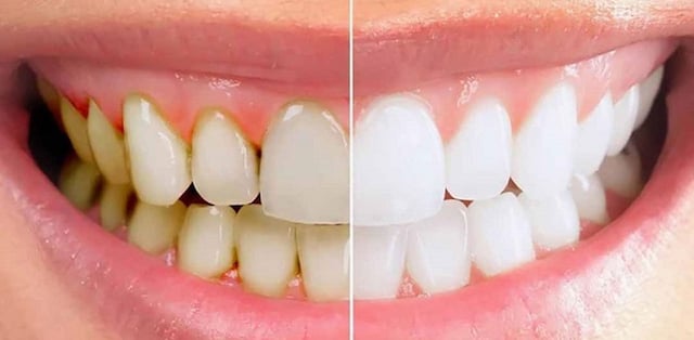 Lấy cao răng sóng siêu âm &#8211; Bước tiến hoàn hảo của nha khoa