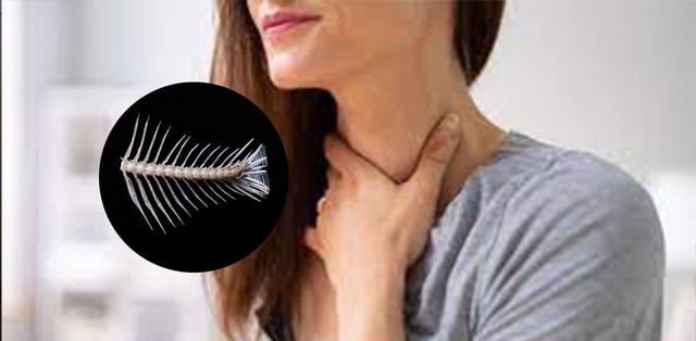Lấy xương cá khi bị hóc sai cách &#8211; Coi chừng những hệ lụy