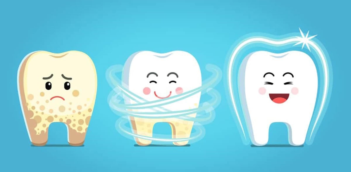 Tư vấn cách loại bỏ mảng bám trên răng hiệu quả