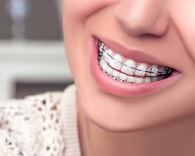 Tiêu chí lựa chọn nha khoa niềng răng phù hợp