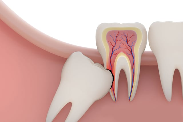 Những ảnh hưởng từ nhổ răng khôn không khâu