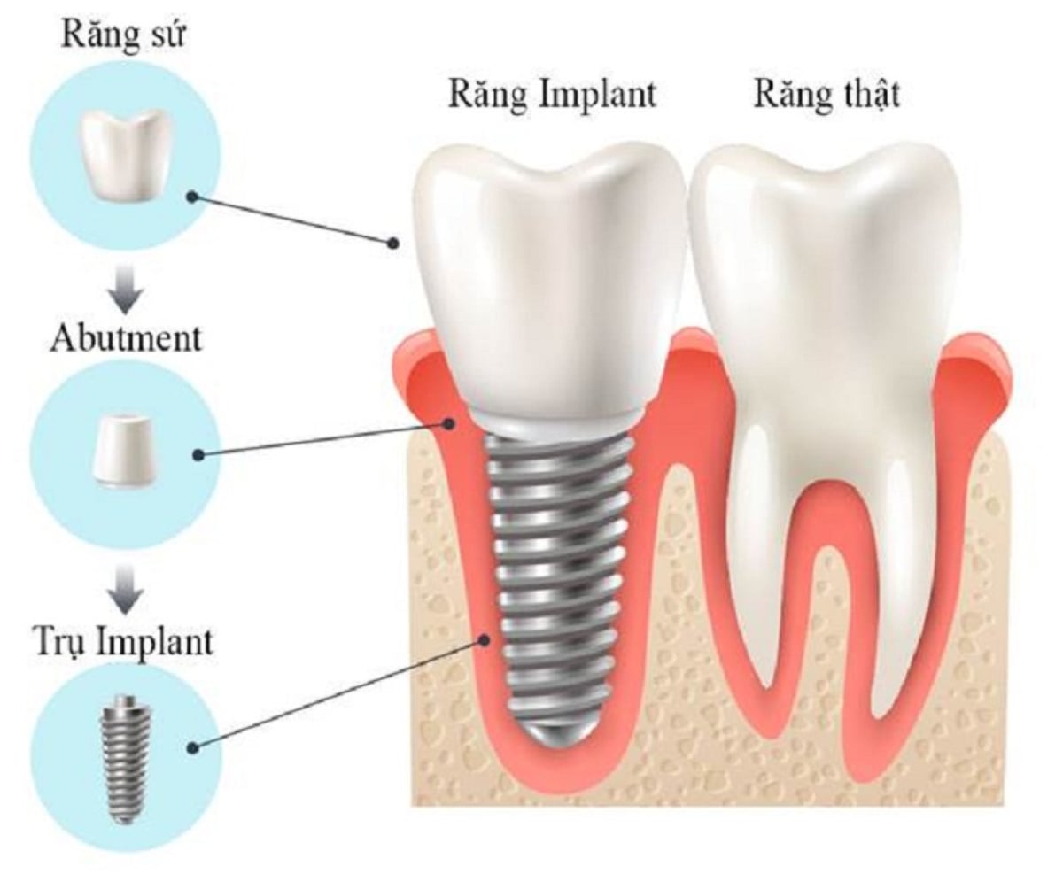 Tìm hiểu những thông tin về quá trình cấy ghép Implant
