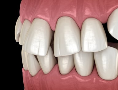 Tại sao răng mọc lệch và cách khắc phục