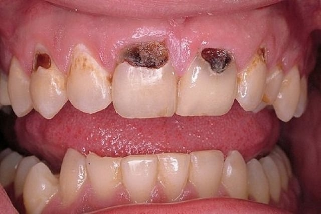 Sâu răng cửa ở người lớn và cách xử trí