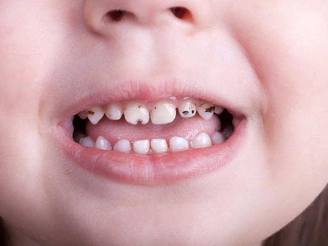 Sự thật về việc sâu răng di truyền