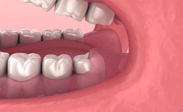 Lưu ý khi bị sưng nướu răng trong cùng