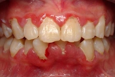 Thuốc bôi trị viêm nướu răng và những điều cần biết