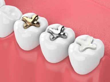 Tìm hiểu về trám răng sâu lỗ nhỏ