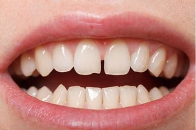 Hàn răng thưa hết bao nhiêu tiền và những điều cần lưu ý