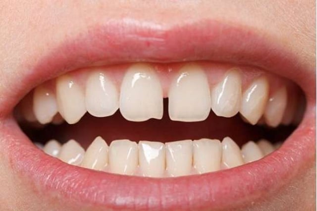 Hàn răng thưa hết bao nhiêu tiền và những điều cần lưu ý