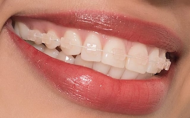 Tư vấn niềng răng: Những điều bệnh nhân cần lưu ý