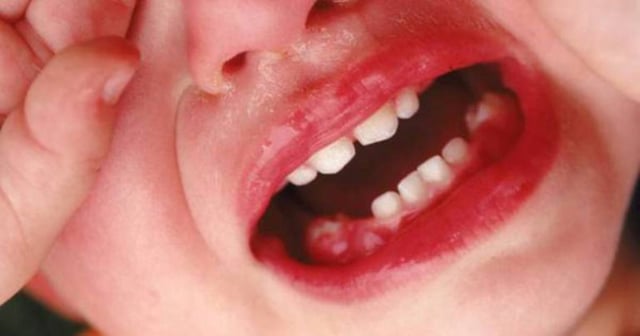 Viêm lợi gây sốt ở trẻ em và những việc cha mẹ nên làm