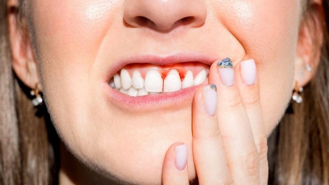 Viêm lợi: Phát sinh do thiếu Vitamin, khoáng chất