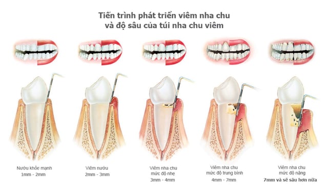 Viêm nướu và bệnh nha chu: Phân biệt và cách chữa