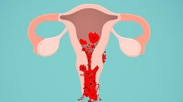 Rong kinh là gì và dấu hiệu rong kinh chị em không nên bỏ qua