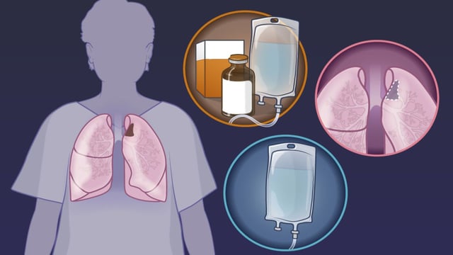 Chữa ung thư phổi không tế bào nhỏ bằng hóa trị