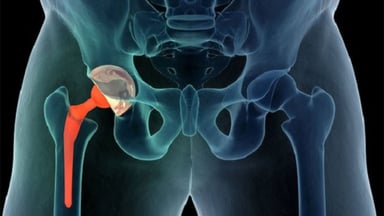 Tìm hiểu thông tin phẫu thuật thay khớp háng 