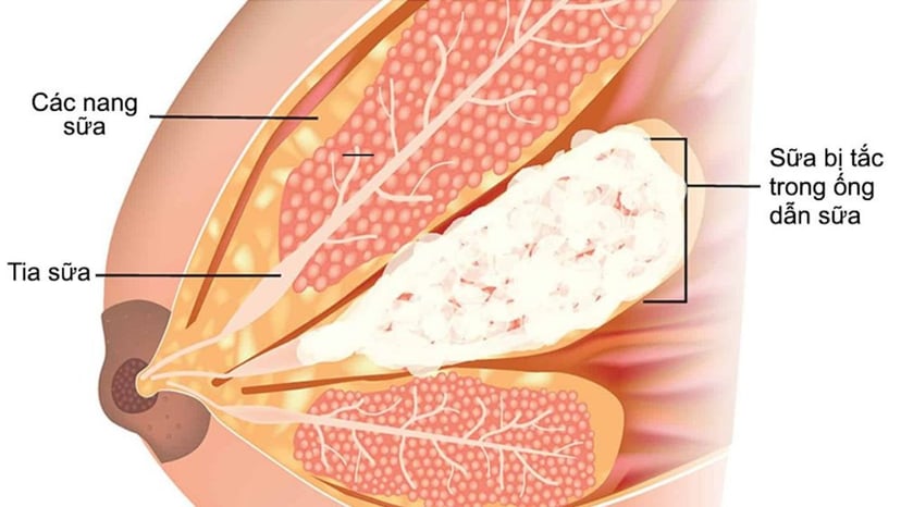 Tắc tia sữa: nguyên nhân và biểu hiện nhận biết
