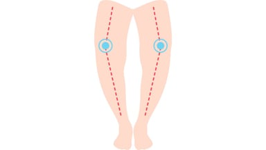 Trẻ còi xương: Những nguyên tắc điều trị cốt lõi
