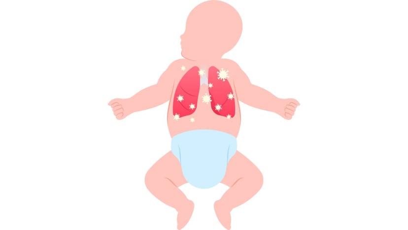 Trẻ sơ sinh viêm phổi: Nhận biết sớm để điều trị kịp thời