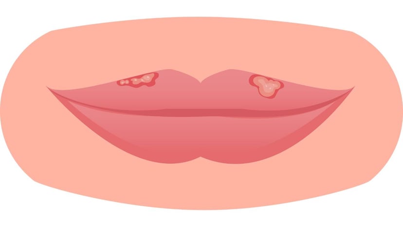 Bệnh Herpes là gì, giải đáp của chuyên gia