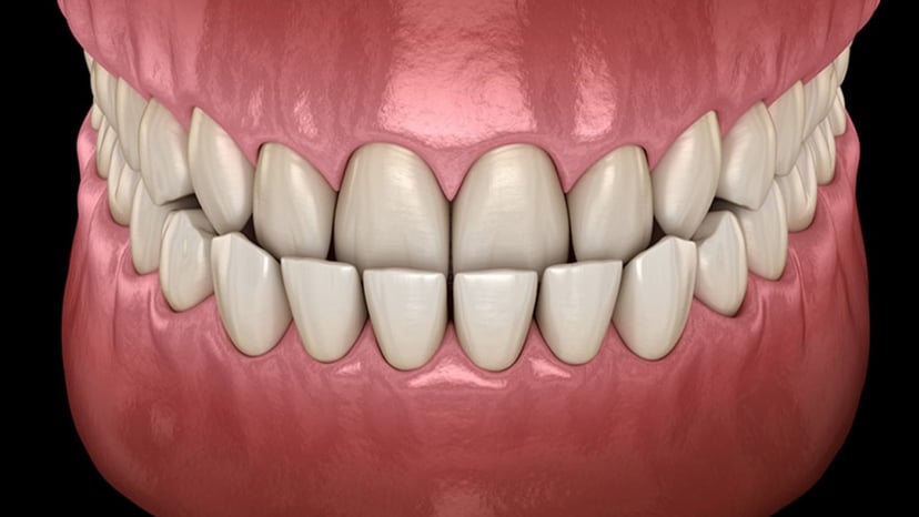 Biến chứng bọc răng sứ bị lệch khớp cắn