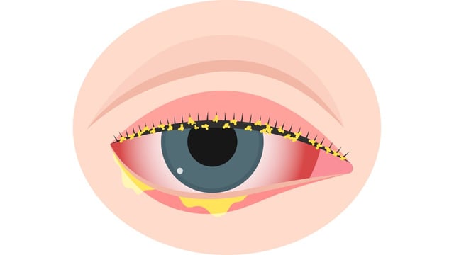 Tổng hợp dấu hiệu đau mắt đỏ: Biết để nhanh chóng xử lý