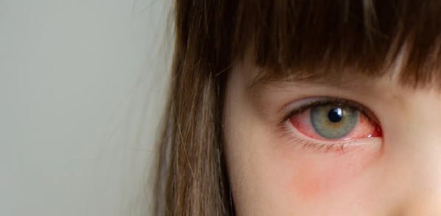 Hướng dẫn chi tiết cách chăm sóc người bị đau mắt đỏ