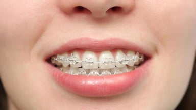 Chỉnh nha niềng răng &#8211; Những điều cần biết trước khi thực hiện