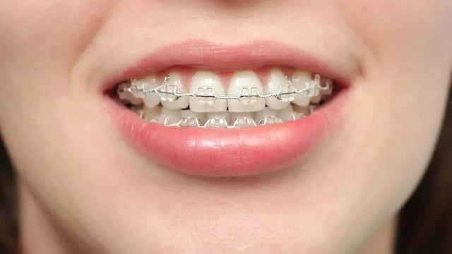 Niềng răng pha lê &#8211; Những điều cần biết trước khi thực hiện